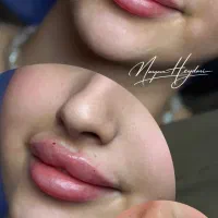 ژل و بوتاکس باآفر ویژه و قیمت منصفانه