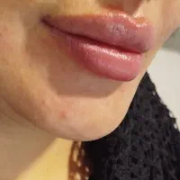 بوتاکس، فیلر،بایوفیلرومزوتراپی ،عملهای زیبایی زنان