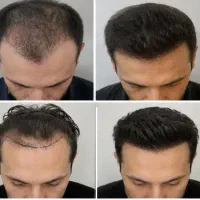کاشت مو/توسط پزشک/ کرج تهران/ کاشت با تراکم بالا