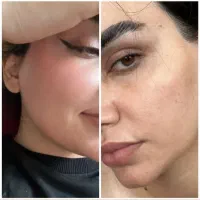 درمان تضمینی هر نوع لک در صورت نارضایتی برگشت وجه