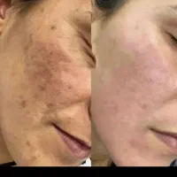 برداشتن خال کک مک لک بستن منافذ،آنزیم بینی فیشیال