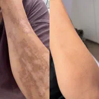 ماکولار (لک تیره پوستی)