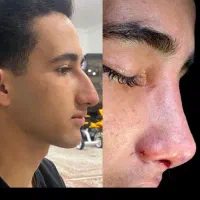 جراحی زیبایی بینی
