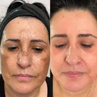 ضدلک و ضدچروک بیوممتیک با ضمانت نامه
