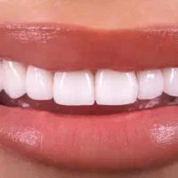خدمات دندانپزشکی به مدت بیست روز 50 درصد تخفیف