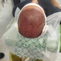 کاشت تضمینی مو،ابرو ،ریش
