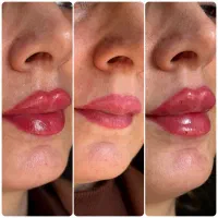 اف ویژه ی خدمات زیبایی لب لیفت شده