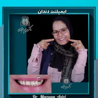 اقساط ویژه ایمپلنت دندان / قطب دندانپزشکی شیراز