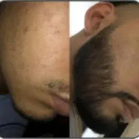 رویش مجدد ریش سبیل