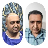 جشنواره ویژه کاشت مو با اقساط وبالاترین تراکم