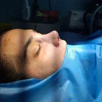 جراحی بینی/رینو پلاستی