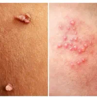 دفع قطعی و بدون بازگشت زگیل و تبخال تناسلی