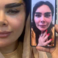 سوپر لیفت کره با نخ ابرو صورت در ۲۰دقیقه توسط پزشک