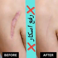 لیزر و رفع رد بخیه و اسکار