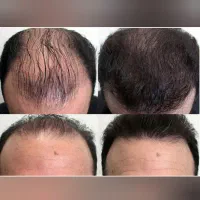 نانوکیت معجزه پرپشتی مو