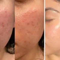 جشنواره تخفیفاتی ویژه فشیال تخصصی و درمانی پوست