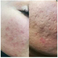 پلکسر، مزونیدینگ صورت و مو، مزوتراپی، بوتاکس