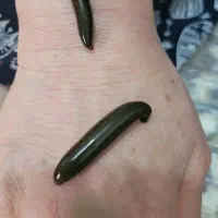 حجامت و زالو درمانی می کند آنچه داروها نمی‌توانند