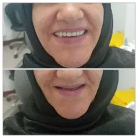 دندان مصنوعی (ضمانت زیبایی/ضمانت بازگشت وجه)