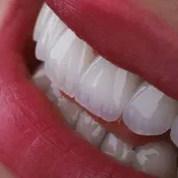 دندانپزشکی ایمپلنت فوری بدون درد