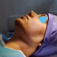 ساکشن غبغب،بلفاروپلاستی،جراحی توده،لیپوساکشن|خدمات آرایشگری و زیبایی|اصفهان, شهریار|دیوار