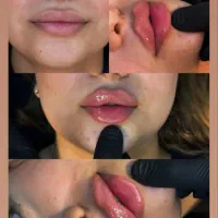 جشنواره ویژه بوتاکس،فیلر،آنزیم،لیزر،مزوژل جوانساز