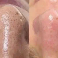 ماسک کربن فعال ویتابلا (پاکسازی عمیق و رفع جوش)