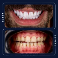 کامپوزیت/لمینت/اقساط12 ماه/دندانپزشکی/ایمپلنت