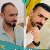 کاشت مو اقساطی، تضمینی بدون پیش پرداخت در اهواز