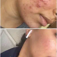 پک ضد جوش بیوممتیک