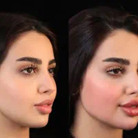 تزریق ژل بوتاکس