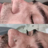 لیزر خال و زگیل تناسلی