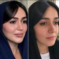 جشنواره تخفیفی ژل و بوتاکس/شرایط ازدم قسط
