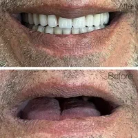 دندان مصنوعی کره‌ای / هر فک فقط ۱۴.۹ میلیون