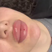 ژل و بوتاکس قبمت مناسب