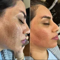 لیزر تتو و روشن سازی /لیزر موهای زائد