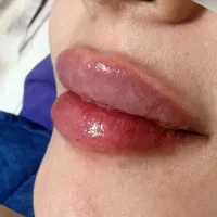 ژل،تزریق فیلر، جوانساز،بوتاکس توسط پزشک/ لیفت صورت
