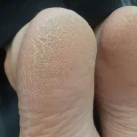 پدیکوروکفسابی(تخفیف اسثنایی)
