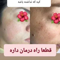 پاک کردن تتو،پیلینگ کربن،وایتینگ،ازبین بردن لک