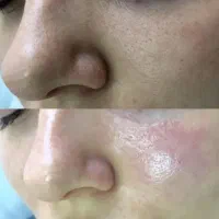 تخفیف ویژه آموزش فیشیال و پاکسازی پوست