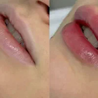 ساکشن غبغب و ژل و بوتاکس