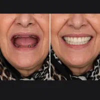 ایمپلنت دیجیتال/کامپوزیت/روکش/عصب کشی/دندان مصنوعی
