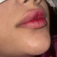 تزریق بوتاکس و ژل لب، گونه و...