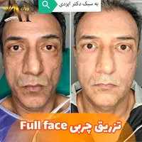 فیلر بادی، جراحی سرپایی زیبایی حجم دهی صورت بدن|خدمات آرایشگری و زیبایی|مرودشت, رودبال|دیوار