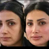 تزریق ژل کره ای اصلی از سیسی ۴۵۰ به بالابوتاکس ۸۰۰