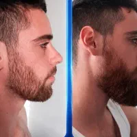 ریشات رو گیاهی پرپشت کن
