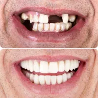 اصلاح طرح لبخند ،ایمپلنت ،زیبایی با پرداخت اسان