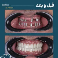 ایمپلنت۸میلیون/دیجیتال/فوری/اقساطی/عصب کشی