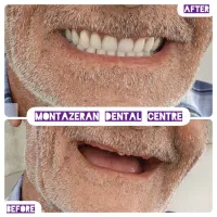 لمینت / دندان مصنوعی یک روزه دندانسازی