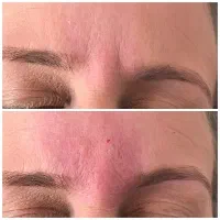 بوتاکس بوتاکس